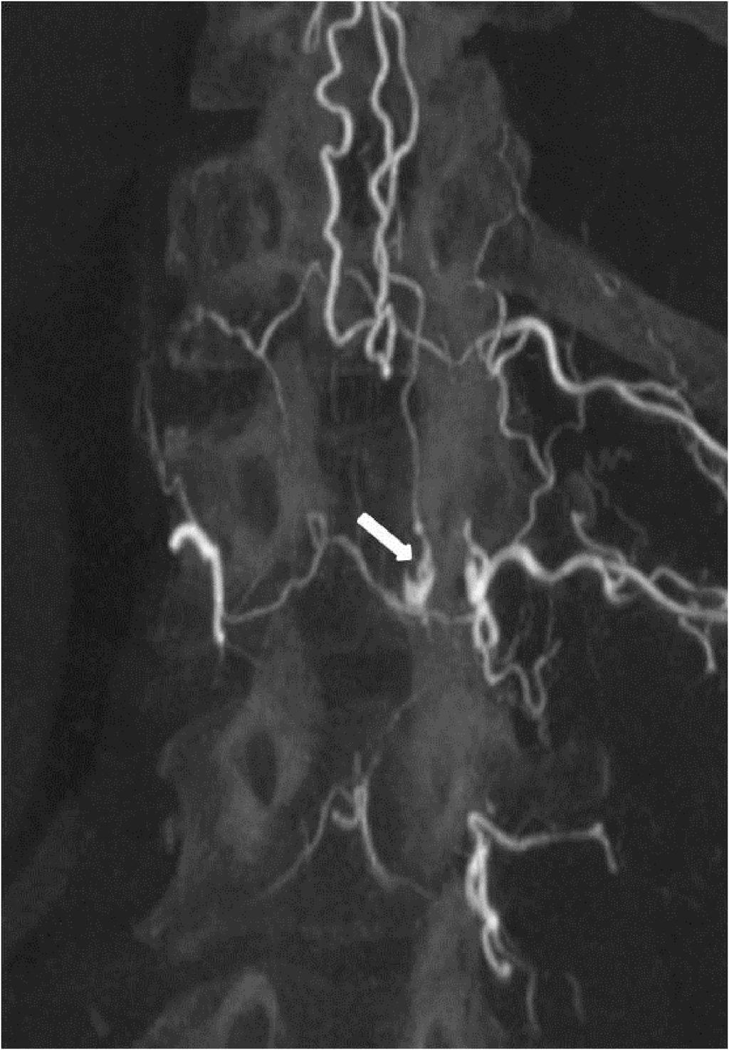 Spinal dural AVF demonstrated on the conventional DSA. The arrow points to the fistula.