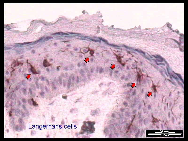 Pathogenesis and Etiology Cell of origin: LC from the skin or other histiocytes cells acquiring phenotype LCH cells possess LC markers (CD1a, CD207) and DC markers (CD80, CD86, and