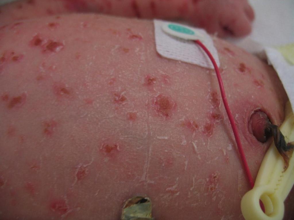 Congenital self-healing histiocytosis Presents as asymptomatic, red, brown, or pink, crusted papulonodular and/or