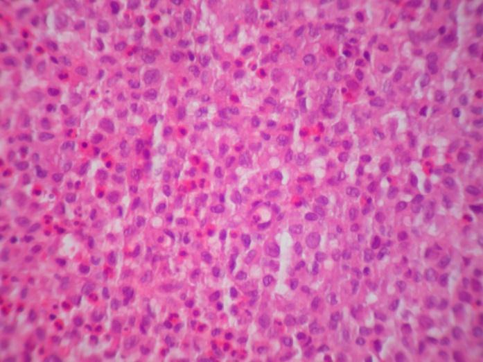 Histology of LCH Diffuse infiltration by pleomorphic