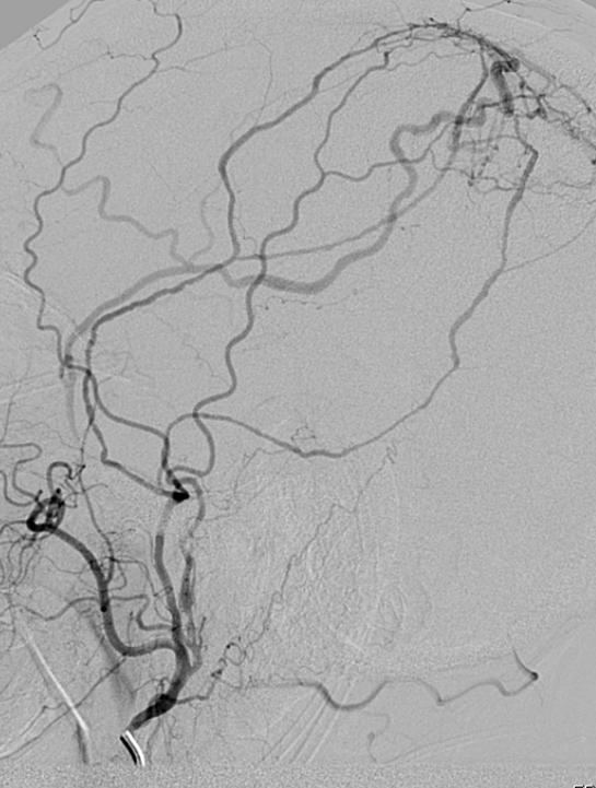 Convexity / Superior Sagittal Sinus 3:1 Male:Female Venous Drainage 6% Type 1 13% Type 2 50% Type