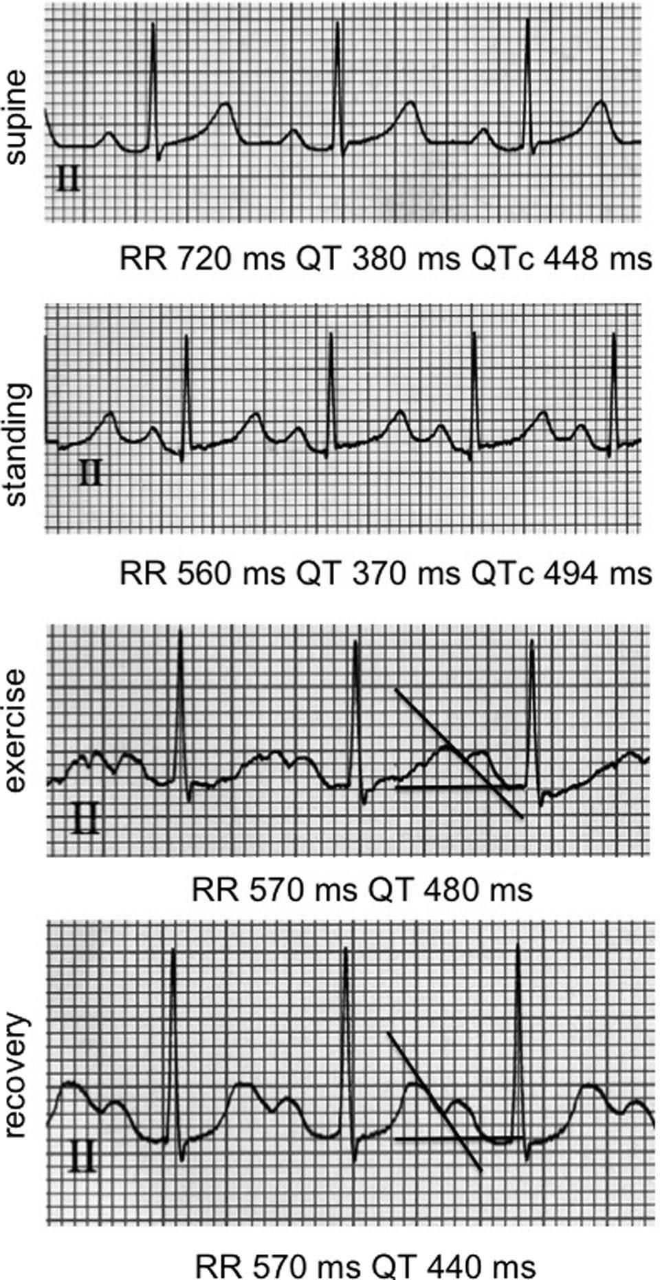 124 Circ Arrhythm Electrophysiol April 2010 Figure 2. Effect of posture on QTc and QT hysteresis. A, ECGs showing QTc prolongation with postural change in an LQT1 patient.