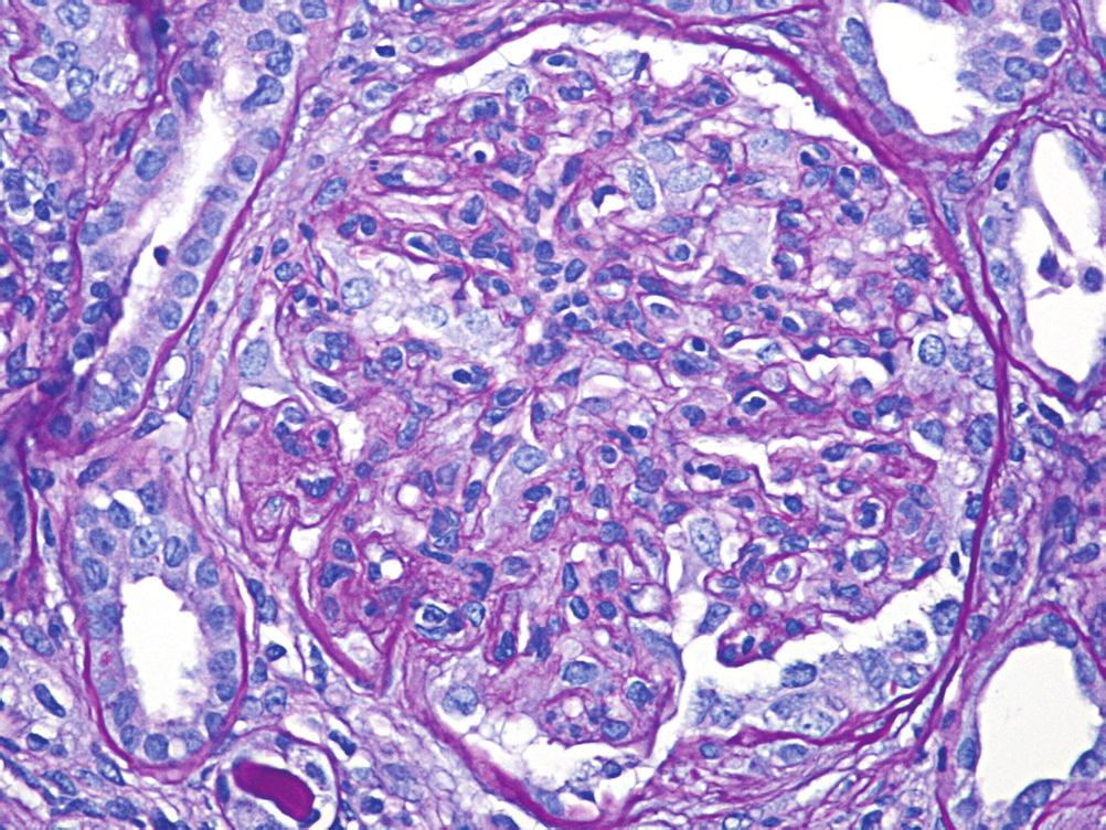 Case Reports in Nephrology 3 Figure 2: Light microscopic finding of kidney biopsy.