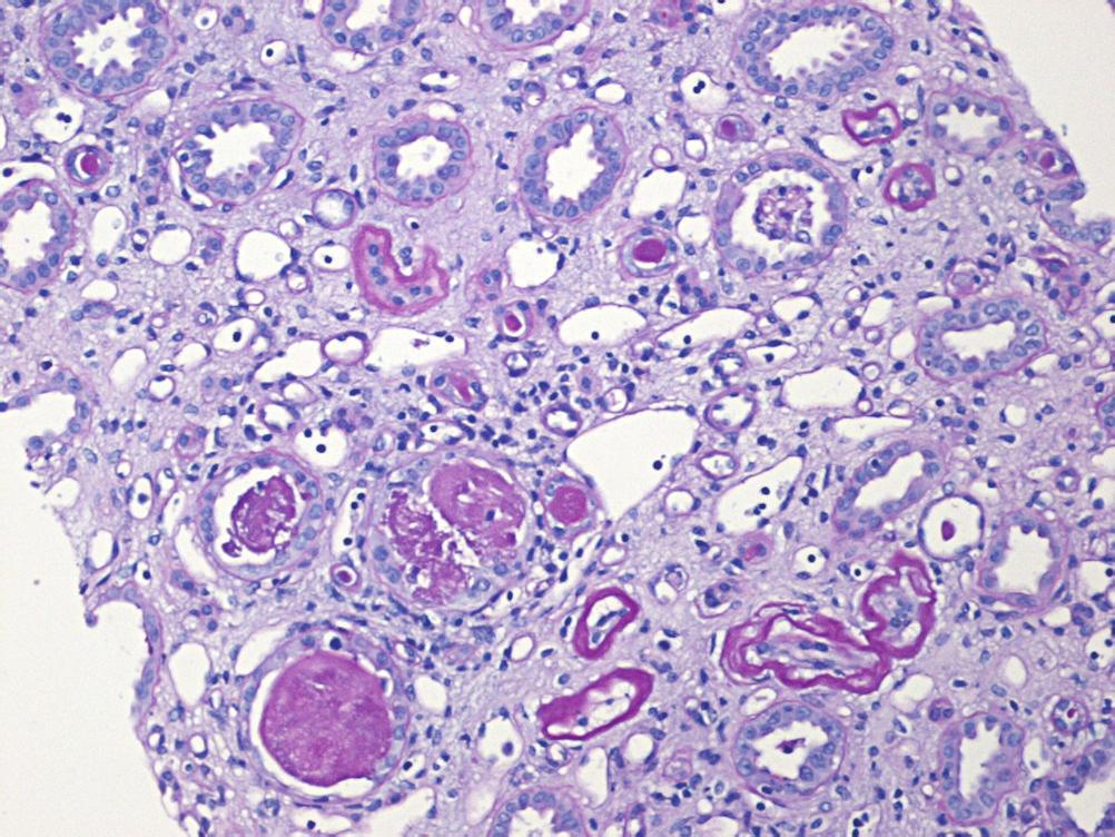 The glomerular capillary loops show patchy endocapillary proliferation and focal mononuclear cell infiltration.