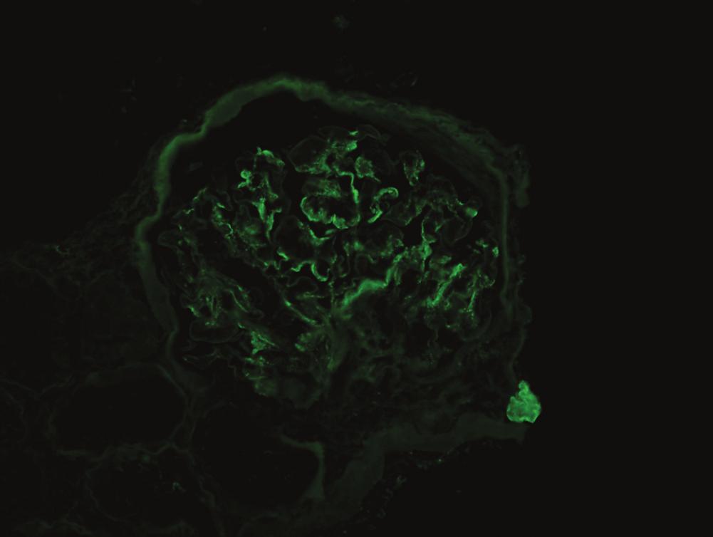 PAS at 2x demonstrates tubules containing intraluminal casts with smooth borders and flattening and sloughing of tubular epithelial