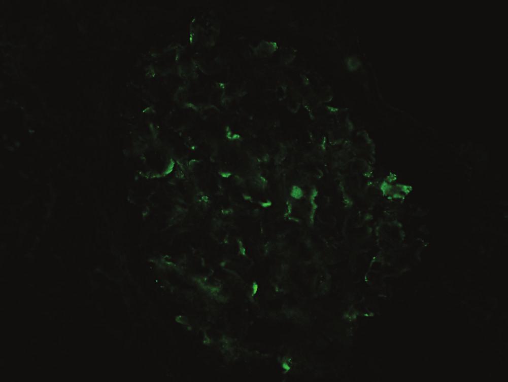 Immunofluorescence staining shows trace mesangial staining for IgG, IgM, and kappa light chain (c) but 2+ mesangial and granular