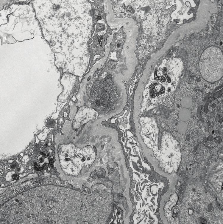 4 Case Reports in Nephrology Figure 4: Electron microscopic finding of kidney biopsy.