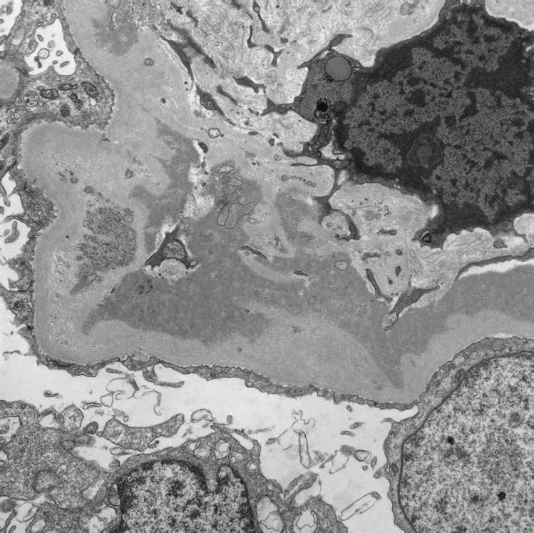The glomerular basement membrane is markedly irregular in thickness, and dense deposits are located in the mesangial areas and focally within subendothelial space without any organized substructural