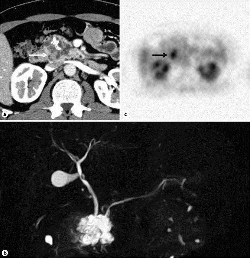 420 Fig. 1. a Contrast-enhanced CT showed a multilocular cystic lesion 4 cm in diameter with calcification in the head of the pancreas.