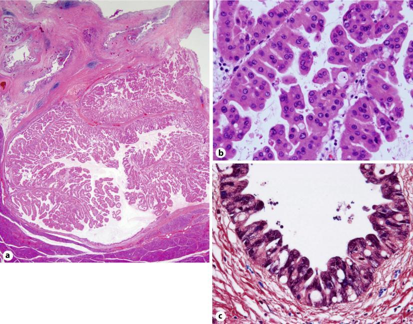 421 Fig. 2. a The cysts were filled with achromatic, transparent mucus. A papillary mural nodule was recognized in one cyst near the duodenum (HE stain, 100).