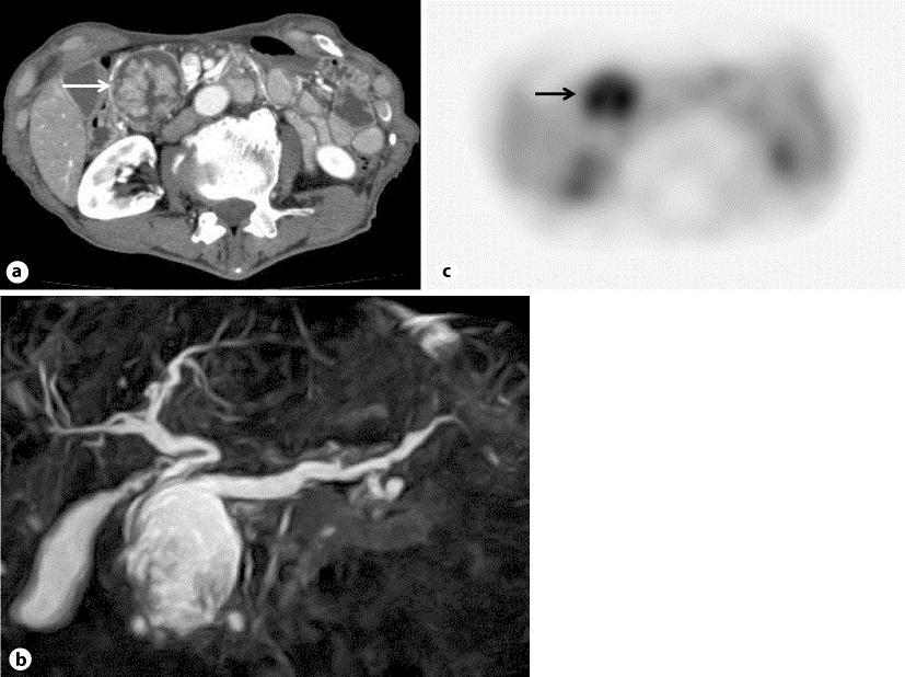 422 Fig. 3. a Contrast-enhanced CT showed a cystic lesion 5 cm in diameter which contained a slightly enhanced papillary mural nodule 4 cm in diameter in the head of the pancreas (arrow).