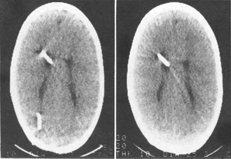 Determination of arrested hydrocephalus FIG. 3. Computerized tomography scans in Case 2. Left: Scan at age 4 89 years, prior to removal of the ventriculoperitoneal shunt.