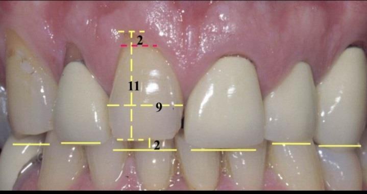 Understand and learn about anterior tooth morphology so you