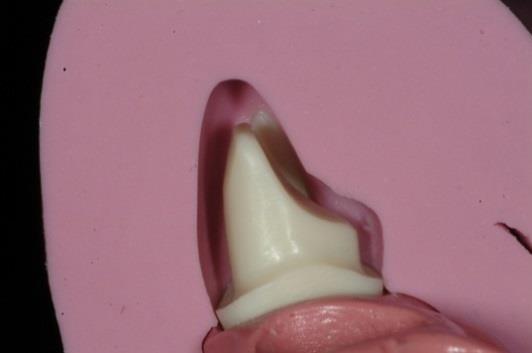 Different types of tooth preparation for different types of crowns Cementation and bonding
