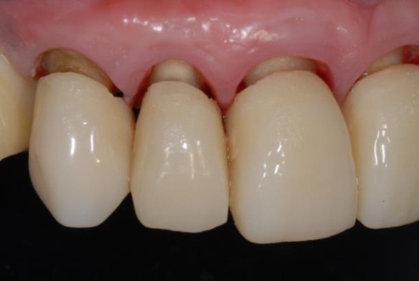 Acrylic resin vs Bis-acryl Improve your temporaries and start treating more complex cases