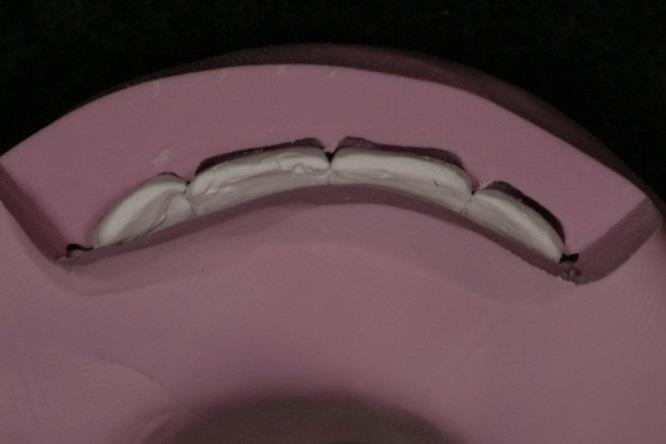 teeth for porcelain veneers Choice of materials for veneers Failures and how to