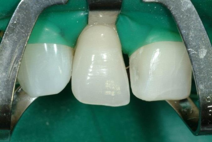 and vertical) Preparation of 4 anterior teeth different preparation designs