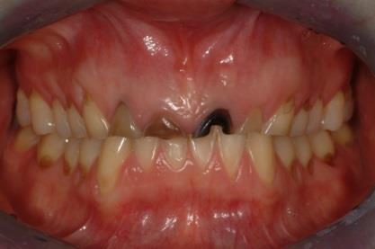 Day 7 - Worn Teeth and Posterior onlays