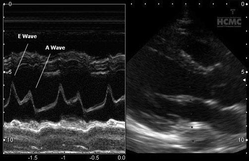 840 Ho et al. HUMAN CARDIAC AXIS TASER APPLICATION Figure 2. Echocardiographic M-mode image of E-A wave peaks of mitral valve and long-axis parasternal view of the heart.