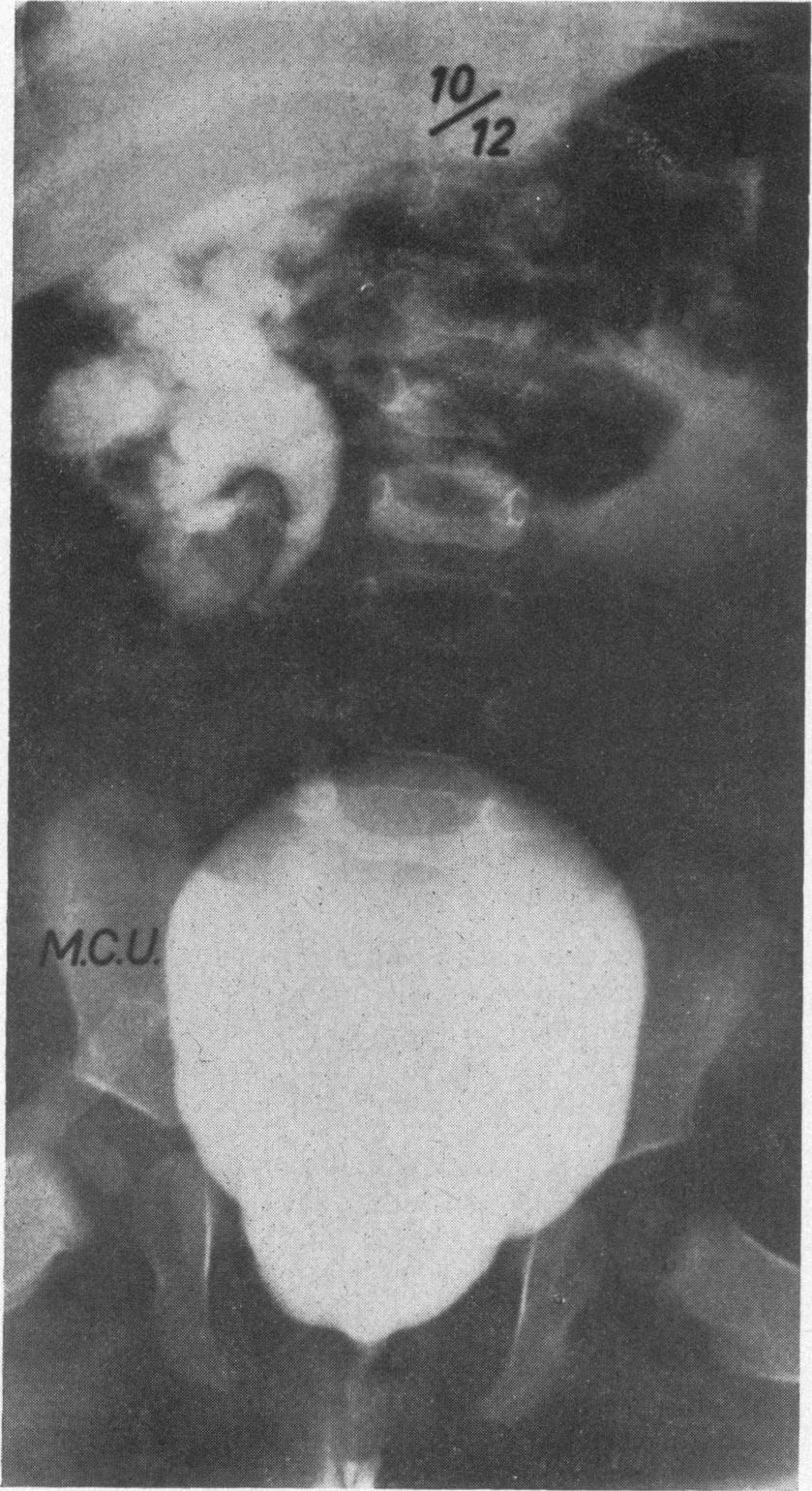 532 Rolleston, Maling, and Hodson the severity of vesicoureteric reflux found in 564 refiuxing ureters during the 386 exaiaions.