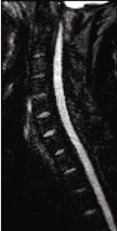 11A 11B Figure 8: RESOLVE images of the c-spine with b=600 mm/s 2 in three volunteers.