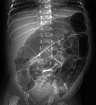 Benign Transient Non-Organic Ileus of Neonates depended upon the symptoms, and ranged from