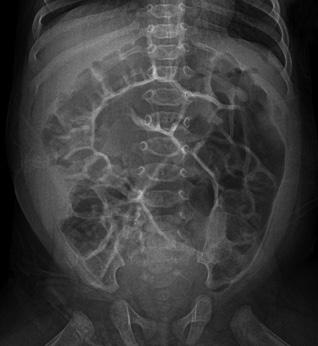 DISCUSSION Although the term of benign transient non-organic ileus of neonate is not well