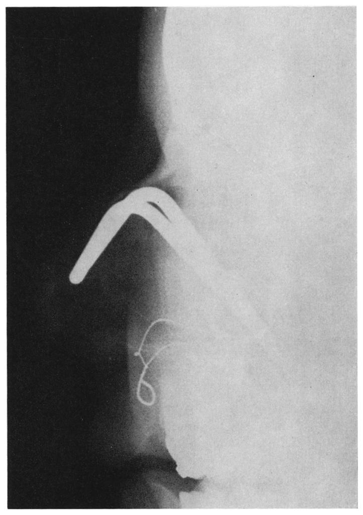 206 BRITISH JOlJRNAL OF ORAL SURGERY FIG. 6. Radiograph of splints supporting fractured nasal bones and upper nasal cartilages. proper.