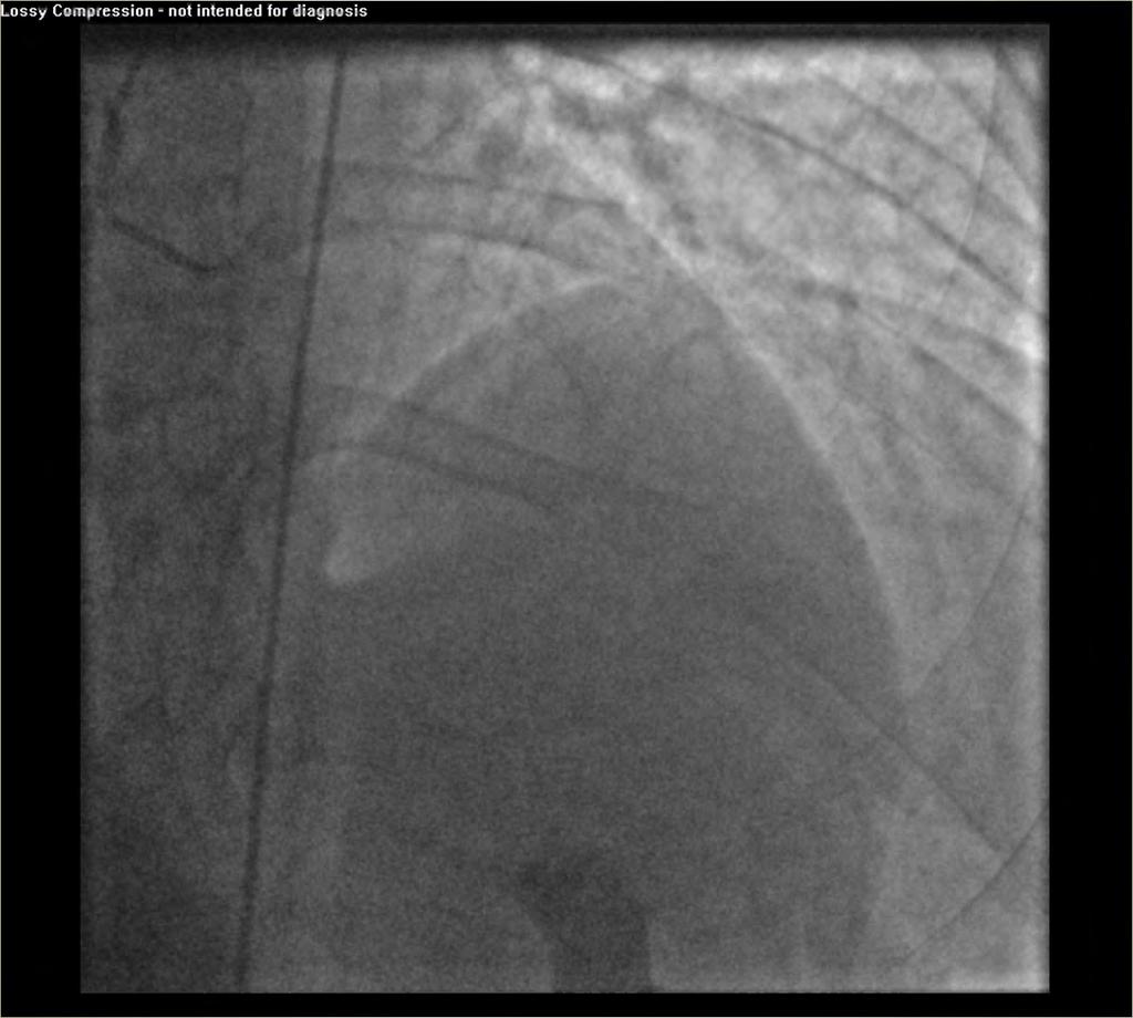 Diagonal Artery to OM