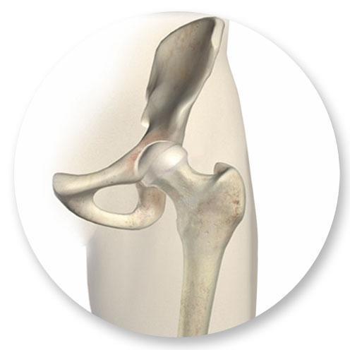 AGENDA How your hip works & why it hurts Hip replacement basics What patients have to
