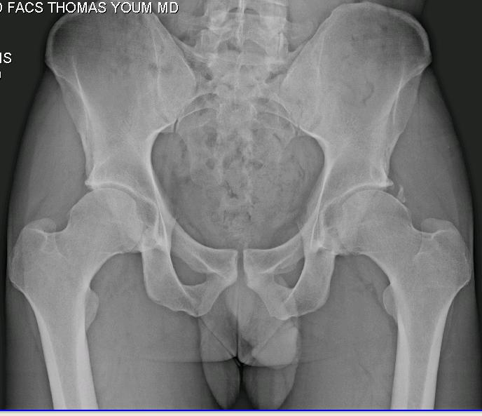 29-year-old man, presented with new stiffness and discomfort, 3months after arthroscopic labral debridement, acetabuloplasty, and femoral neck osteochondroplasty Radiograph showed Brooker Grade 1 HO