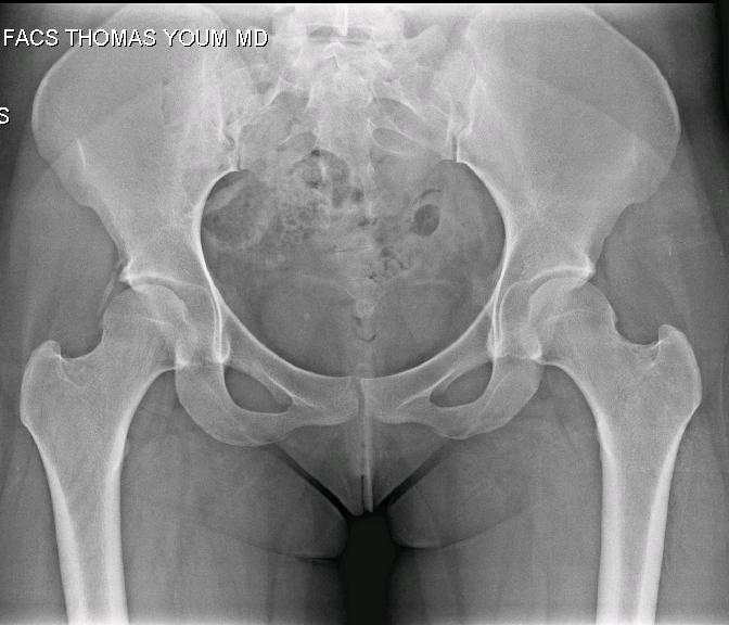 22-year-old woman who 3 months after acetabuloplasty, pincer resection, and labral repair with two anchors, noted pain with flexion to 70 and minimal internal and external rotation Radiograph of