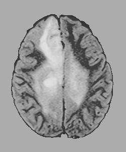 image, enhanced image of tumor images Sl.