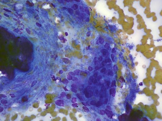 papillary carcinoma, also calcospherites, no evidence of BRAF