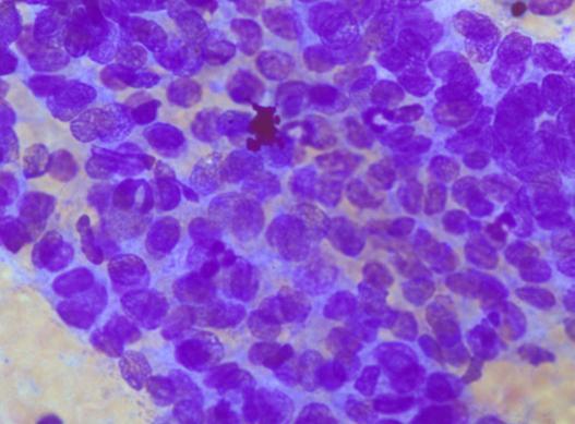 which imply that papillary carcinoma should be considered in the