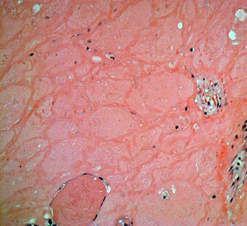 Histology shows a follicular adenoma
