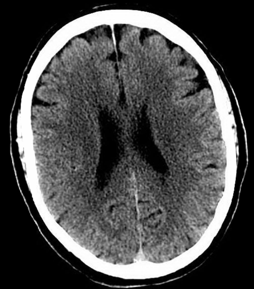 Fig. 1: 65 year old right handed man presented to the emergency department with acute onset of left sided weakness in his face, arm and leg.