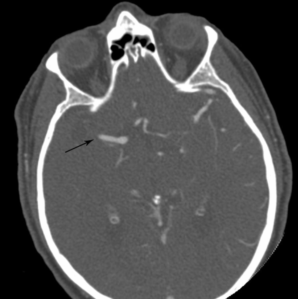 Fig. 2: Axial CT angiogram demonstrates a cutoff in the distal M1 segment (arrow)