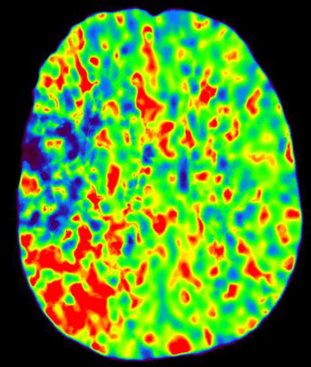 Fig. 3: Axial MTT map shows low central area in blue