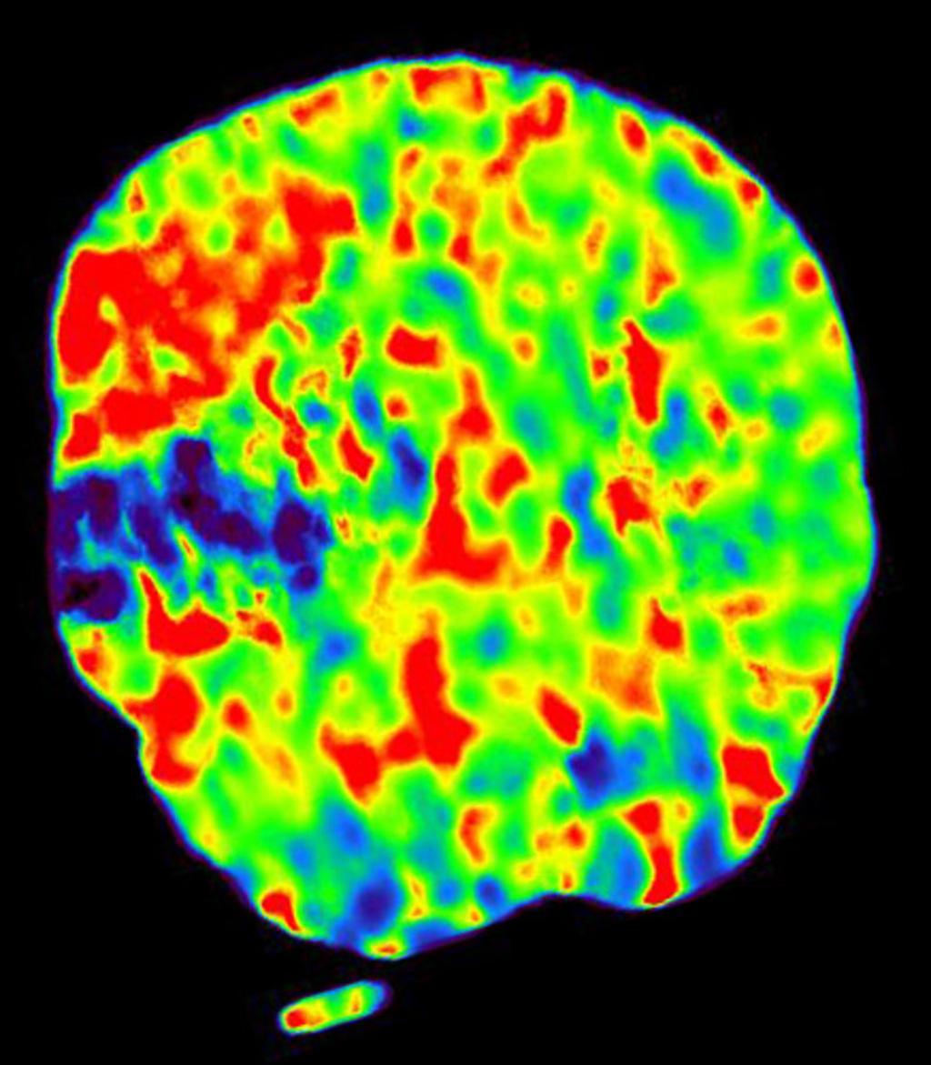 Fig. 6: Coronal MTT map shows low MTT central area in blue