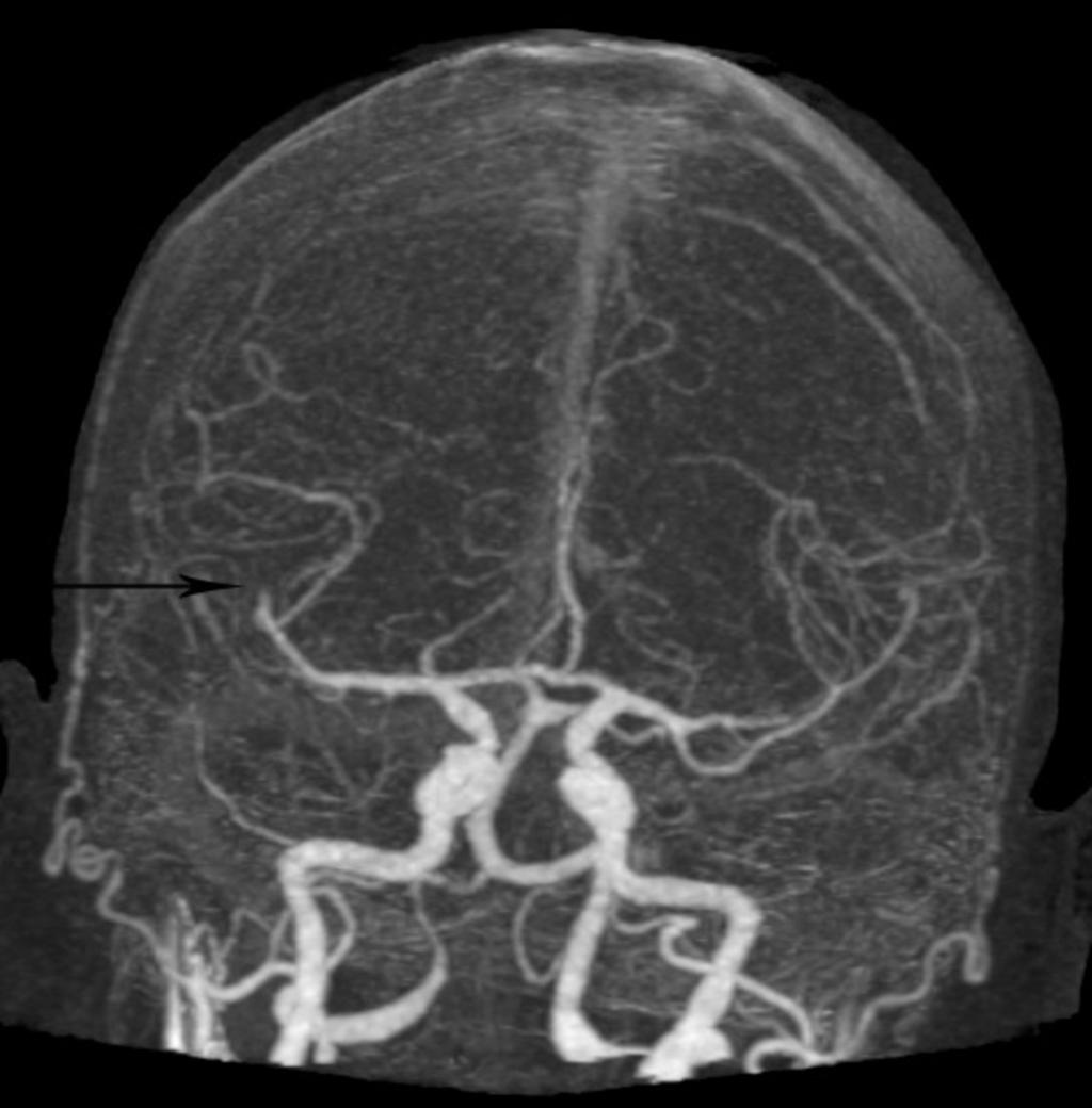 Fig. 1: 83 year old female with sudden onset of left face/arm and leg weakness and slurred speech, history of atrial fibrillation. tpa was administered with no bleeding complications.