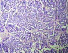 -87. 8. Mahnaz Fatahzadeh. Palatal polymorphous low grade adenocarcinoma: Case report and review of diagnostic challenges.