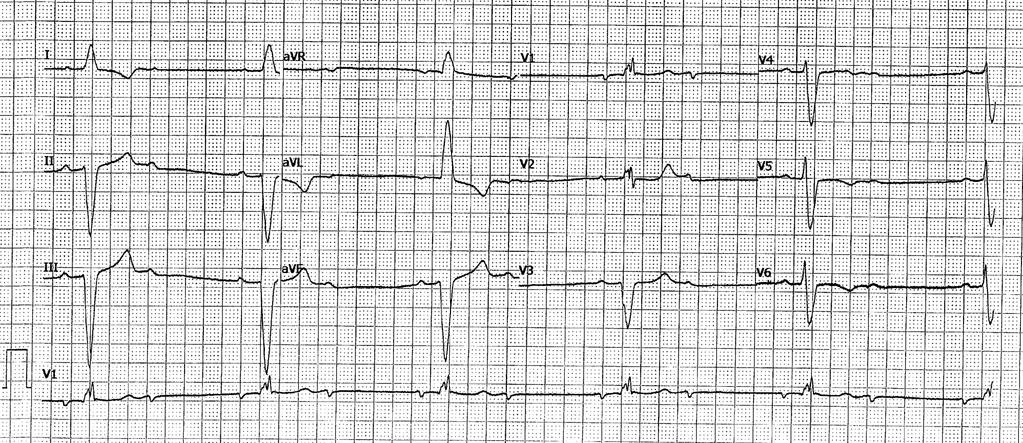 Which ONE of the following is the best ECG diagnosis? a.