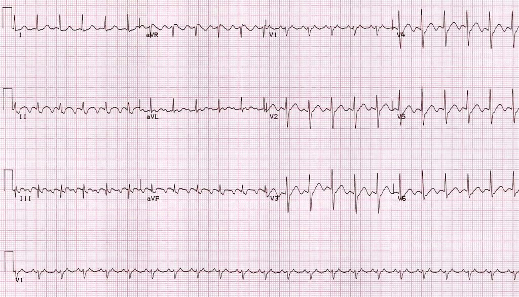 Which ONE of the following is the best ECG di