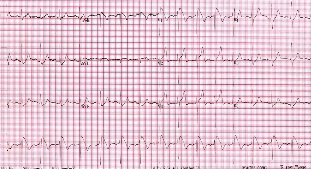 Acute STEMI Which ONE of the following is the best ECG diagnosis? a.