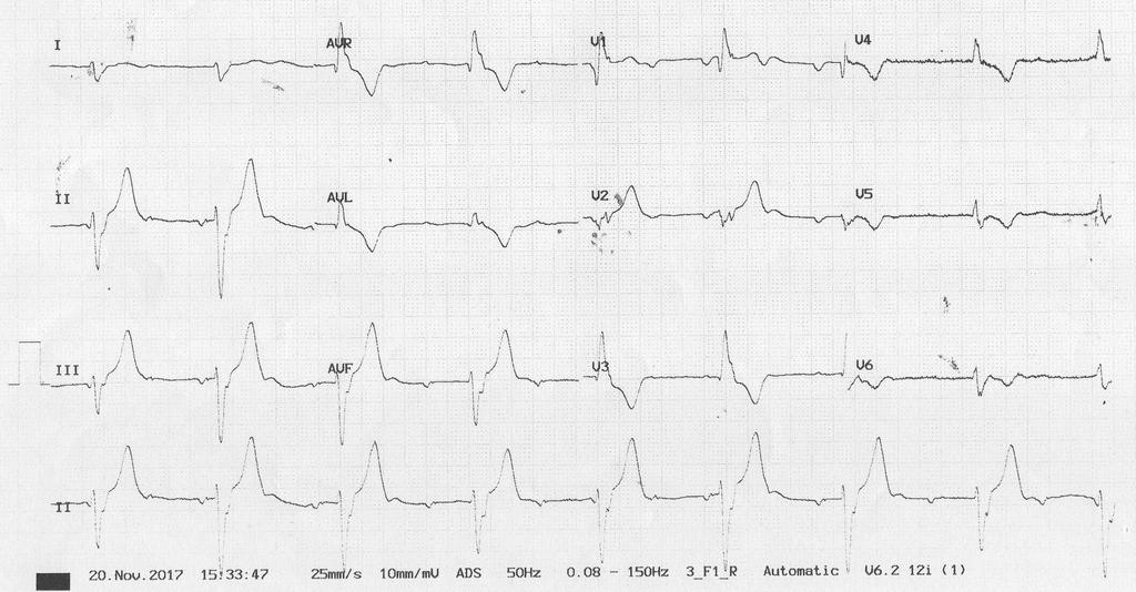 Which ONE of the following is the best ECG diagnosis?