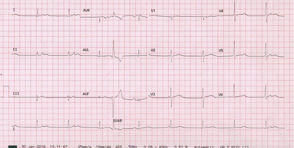 You are called to the casualty department for a request for urgent pacing. What is the diagnosis?
