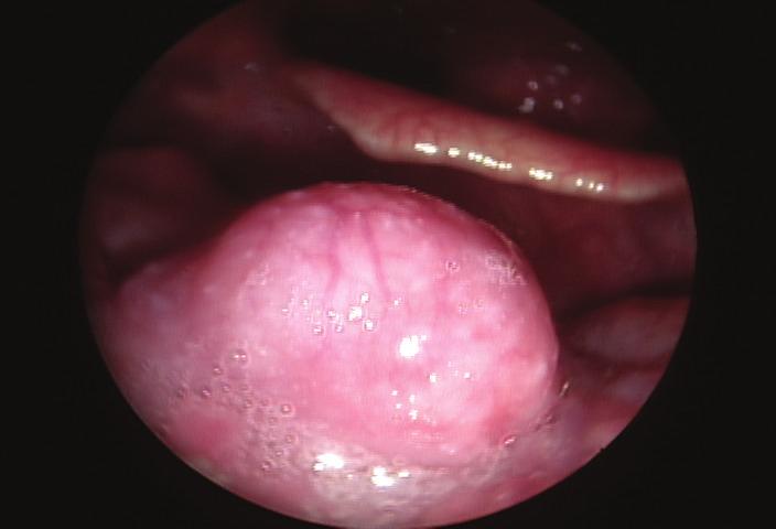 2 Case Reports in Otolaryngology Figure 1: Laryngoscopy of a 54-year-old man with an incidentally detected mass at the tongue base.