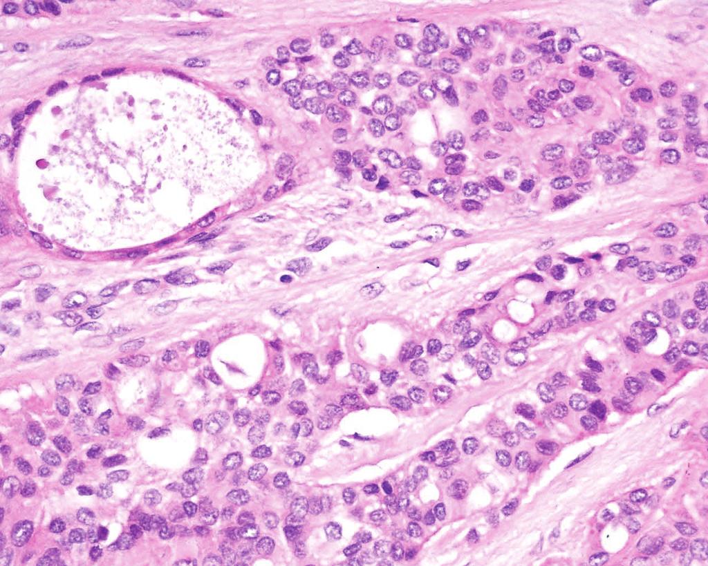 The lesion was wellcircumscribed, but not encapsulated with different growth patterns, such as tubular, trabecular, and cribriform patterns, and the tumor cells were uniform in shape (Figure 2).