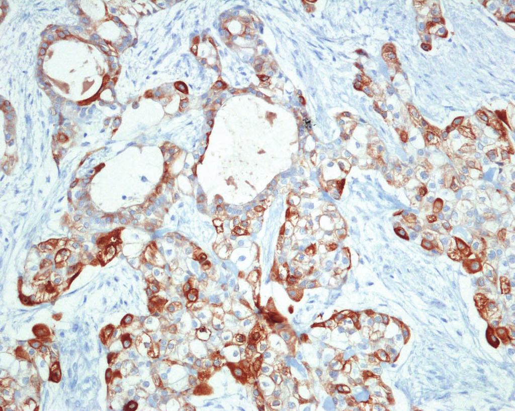 A focal staining pattern was shown for S-100 (c). Figure 4: Laryngoscopy at the 6-month follow-up. No evidence of tumor recurrence was found.